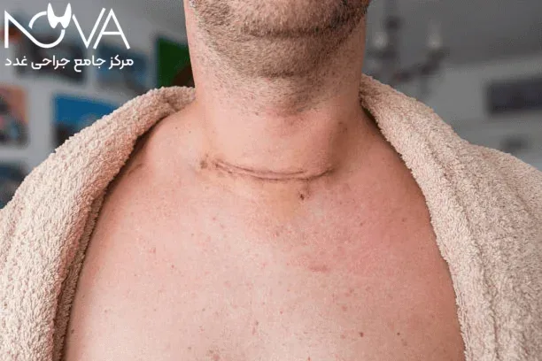 عوارض جراحی کیست تیروئید